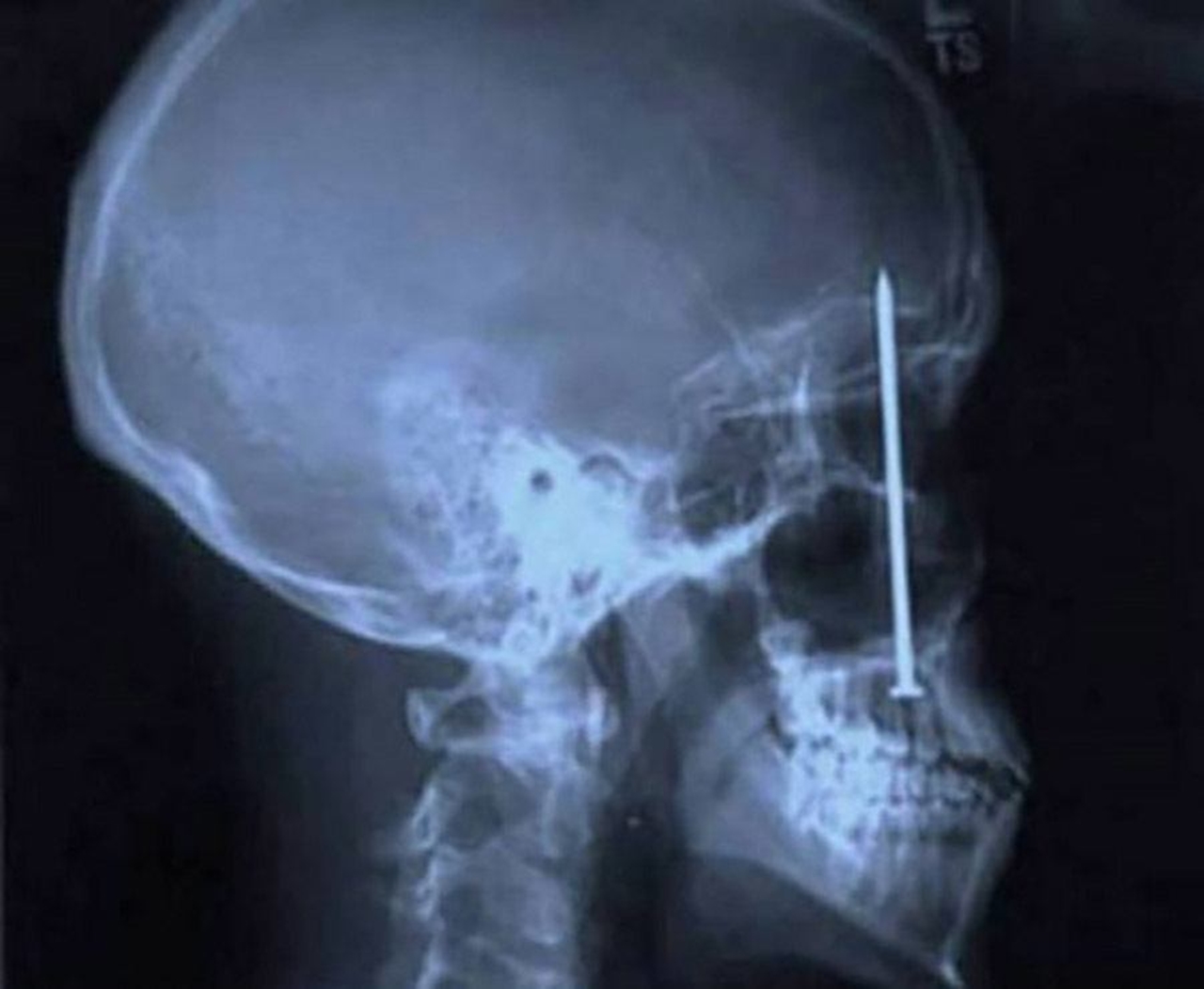 çivi xray